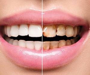 نتیجه تصویری برای این عادت اشتباه دلیل پوسیدگی دندان شماست !