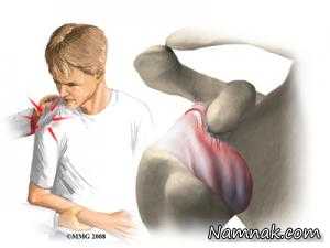 آسیب دیدگی شانه ، ورزش