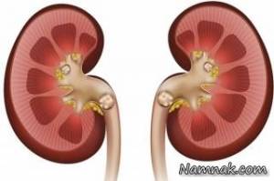 سنگ کلیه ، علت ایجاد سنگ کلیه
