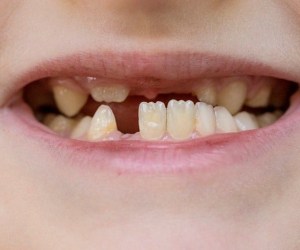 دندان دائمی