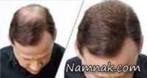 پرپشتی مو