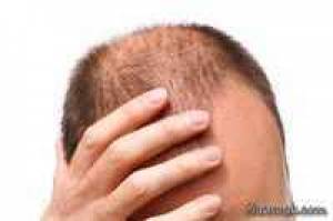 ریزش مو ، علت ریزش مو