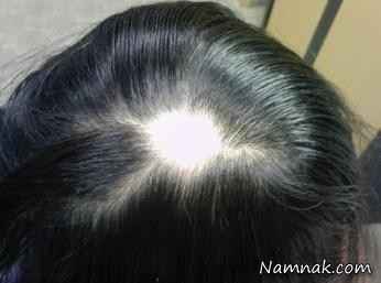 درمان ریزش مو به علت هورمونی