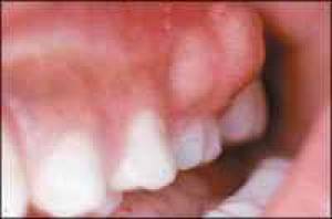 آشنایی با آبسه دندان و درمان آن 1