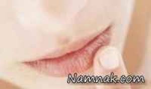 ترک لب،مشکلات لب،پیشگیری از ترک لب،علت ترک لب،خطرات ترک لب ، ترک لب،مشکلات لب،پیشگیری از ترک لب،علت ترک لب،خطرات ترک لب