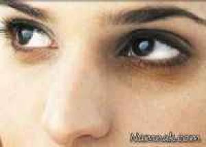 چشم ، کبودی دور چشم