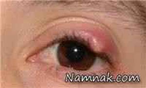 درمان جوش گوشه چشم