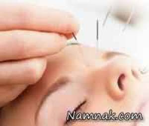 طب سوزنی ، سیاهی دور چشم
