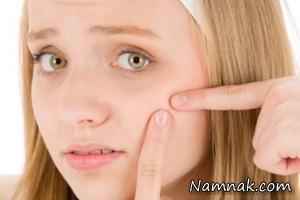 بهترین و سریع ترین راه درمان جوش صورت