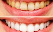 دندان سفید و سالم