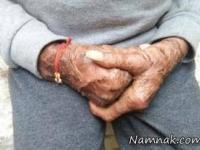 بیماری پوست ماری