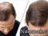 پرپشتی مو