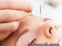 طب سوزنی