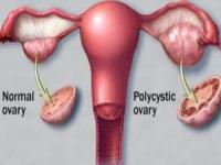 سندرم تخمدان پلی کیستیک pcos