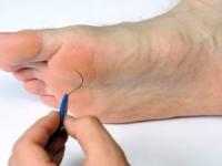 مراقبت از زخم دیابتی