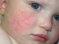 بیماری آکرودرماتیت