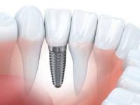 شکست ایمپلنت دندان