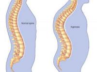 رفع قوز کمر