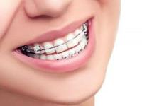 انواع مختلف ارتودنسی