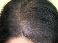 کچلی و ریزش مو
