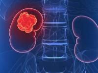 سرطان کلیه