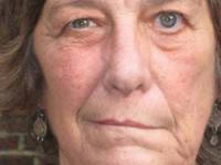 بیماری فلج بلز