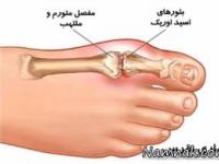 علائم نقرس