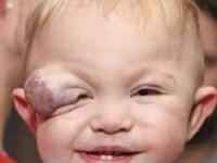 خال مادرزادی کودک