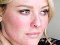 بارداری و لوپوس