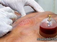 نیاز به حجامت