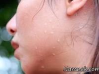 سوزاندن کالری