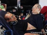 دوقلو های به هم چسبیده