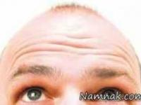 درمان جدید ریزش مو