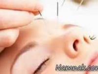 طب سوزنی مثل بوتاکس