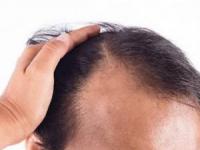 بی خوابی ریزش مو