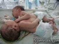 دوقلوهای به هم چسبیده 