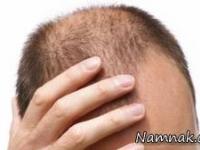 ریزش مو در جوانی 