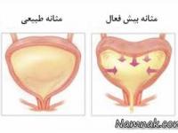 مثانه بیش فعال