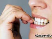 جویدن ناخن