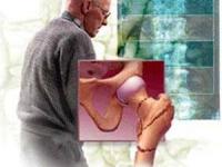 پوکی استخوان