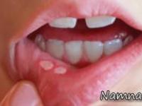 آفت دهانی