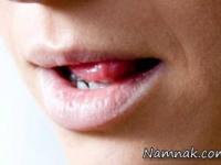 شیرین شدن دهان 