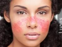 بیماری لوپوس