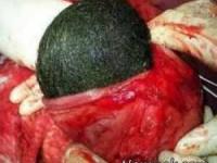 سندروم راپونزل