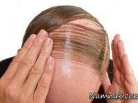 درمان ریزش مو