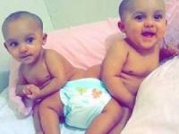 دوقلوهای به هم چسبیده