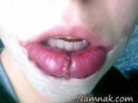 خال مادرزادی