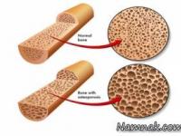 استخوان های ضعیف