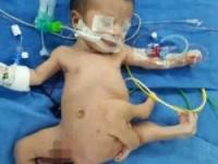 نوزاد 8 دست و پا