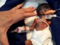 جراحی قلب نوزاد